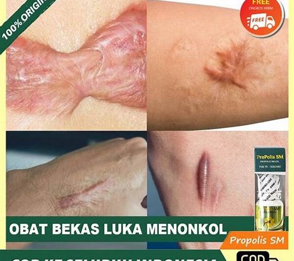Obat Herbal Luka Lecet Alami